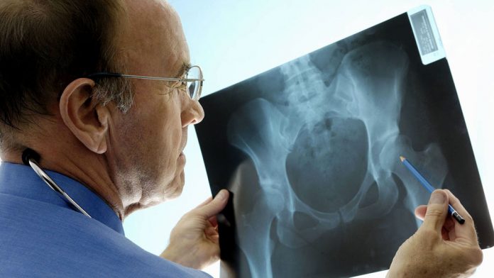 fracturas-por-osteoporosis-tienen-20%-de-chances-de-repetirse-en-el-ano
